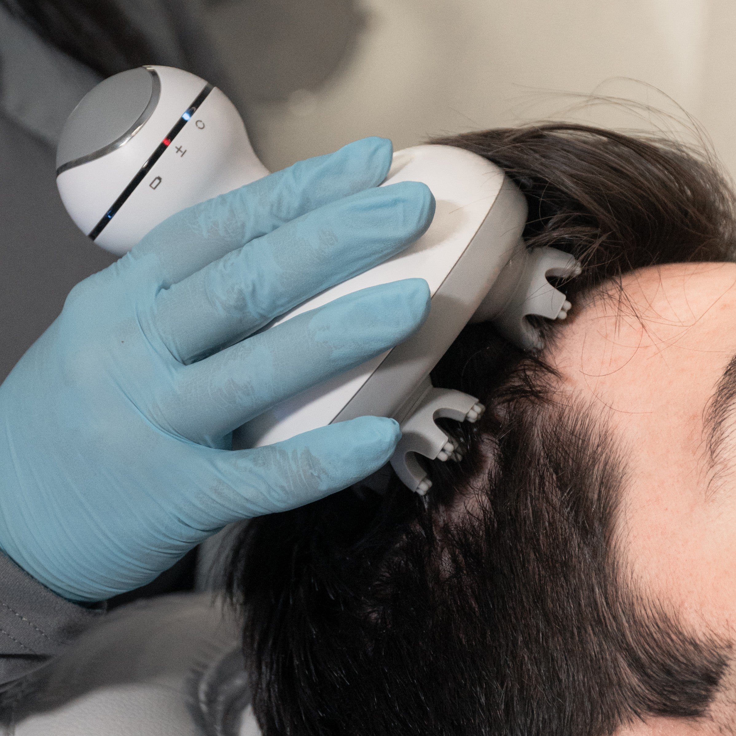 Mesoterapia capilar