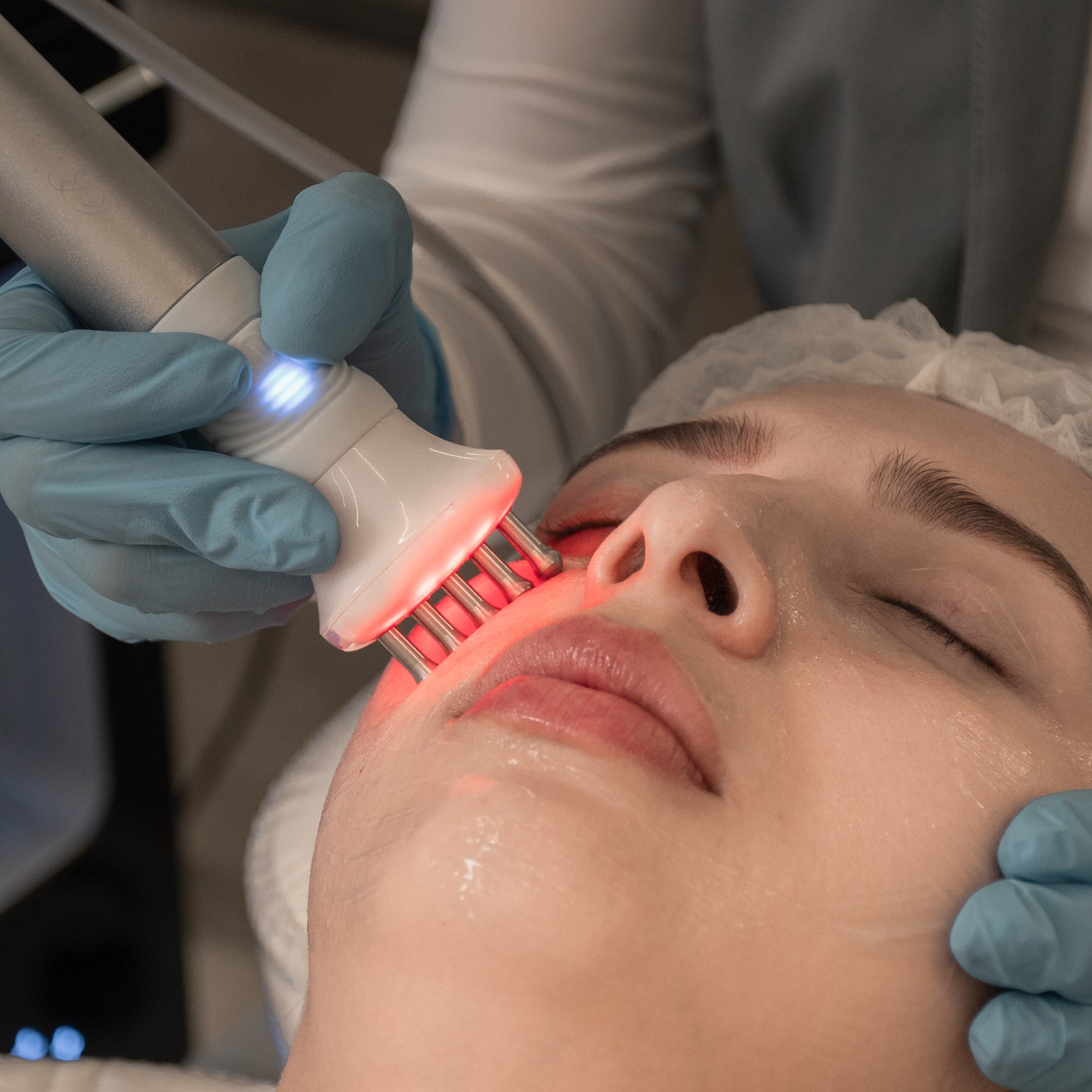 Radiofrecuencia facial